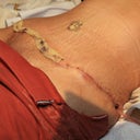 4 day post op, I only got one drain