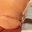 4 day post op, closer look of my drain
