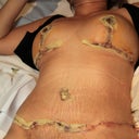 4 day post op