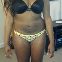 5 Days Post Op: Lower belly is flatter