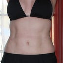 3 months, 3 weeks post op