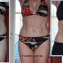 Before, 9 weeks post op, and now - 3 months, 3 wks post op
