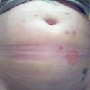 day 4 after my second treatment