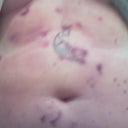 day two after the first treatment