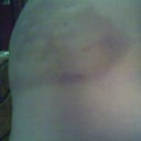 day 3 after my third treatment (side view)