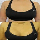 Pre-Op and Post-Op