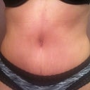 5 weeks post op