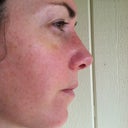 After - Approx. two weeks post op