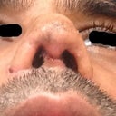 post op1