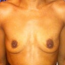 This is a front view of me before implants