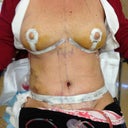 I am a little swolen but this is the 6th official day from surgery. I just got my padding and stuff pulled off and this is the first shots of the results. It looks so great and my nipples look amazing. No implants, just lifts. My tummy is so flat compared to my pics of pre-op. WOW!.