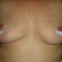 2 days post op