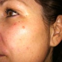Morning after 2nd Treatment