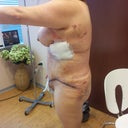 6 days post op!