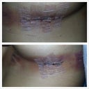 Day 2 Post Op  - some bruising but stitches looks good/clean