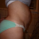 10/18/12 pre op pic 2, right side view