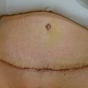 7 days post surgery