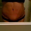 3 weeks post of, lots of swelling above incision line.