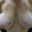 day of surgery Aug. 17, 2012