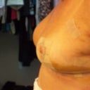 5 days post op