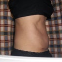 After 8 wks - no "bloating" since surgery.