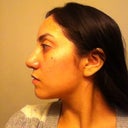 After-4 months, so far I only like the side profile because the hump is gone