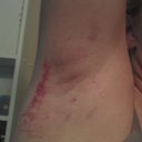 This was after my 2nd treatment.