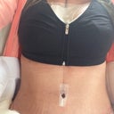 24 hr post op