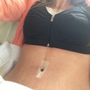 24 hr post op