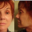 30 hours post-op. Bruised and swollen...but improvement visible.