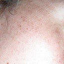 This is Day 2 photo. 26 hrs after procedure appointment. Gridmarks appeared.