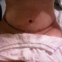 Post OP Day 5