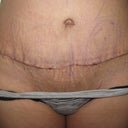 scar close up 3 days after revision