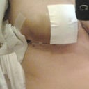 3 days Post-op with surgica tapes on