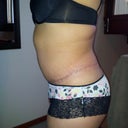 5 weeks P/O side