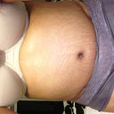 With LOTS of swelling after work on day 20!!