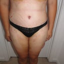 Post-op Day 7