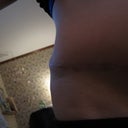 2012 - Dog ear lump before scar revision - 11 & 1/2 months post tt