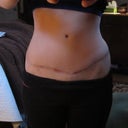 2012 - You can see the thick, uneven scar & lump - before scar revision 11 & 1/2 months post tt
