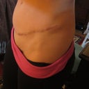 2012 - Thick & ugly scar as well as dog ear lump - before scar revision & 11 & 1/2 months post tt