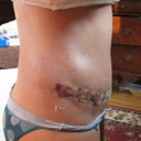 2012 - 11 & 12 months post tt & 1 day after scar revision