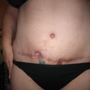 13 week's P/O you can see all the scare the PS is going to remove in this one