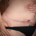 13 week's P/O scar is starting to fad on my hip's woo hoo