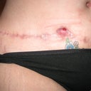 13 week's P/O wound is a lot smaller now