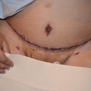 ONE WEEK POST OP..