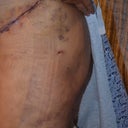 THIGH LIPO AND THE STITCH
