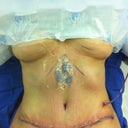 I was still under anesthesia. I asked my Dr. to take pics while I was in there.