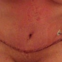 This was day 3 before my first shower after I took out the pain pump.