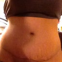 3months scar