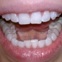 Day 1 - a little crowding in my bottom teeth